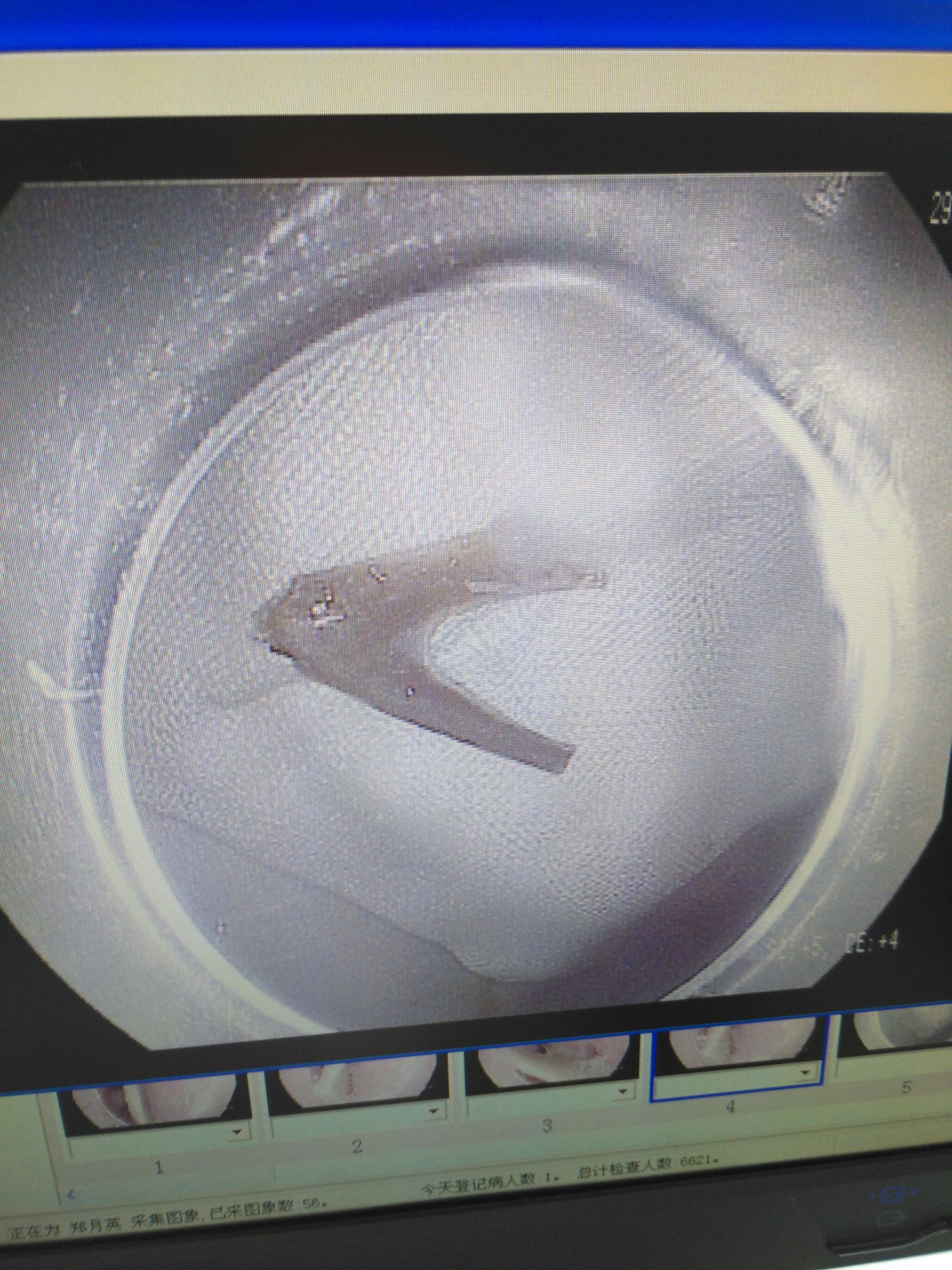 被鱼骨头卡住喉咙最有效方法,骨头卡住食道有什么表现