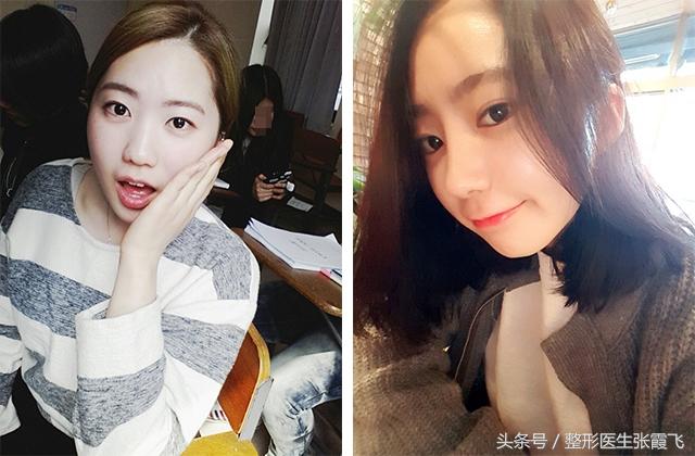 杭州美莱鼻综合最好的医生,杭州格莱美鼻尖整形怎样