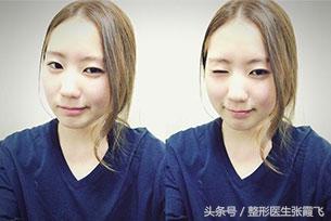 杭州美莱鼻综合最好的医生,杭州格莱美鼻尖整形怎样