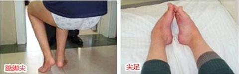 脑瘫宝宝尖足还能治好吗,脑瘫孩子出现尖足症状