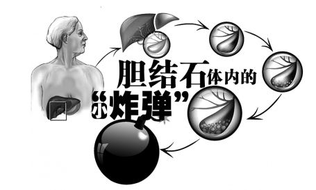 为什么不吃早餐会得胆结石,不吃早餐会得胆结石吗视频