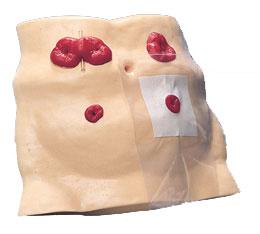 什么是人造肛门？为什么有的能还纳有的要带终身