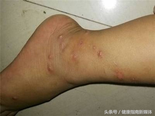 宝宝手上沙土皮炎怎么办,孩子手背沙土皮炎图片