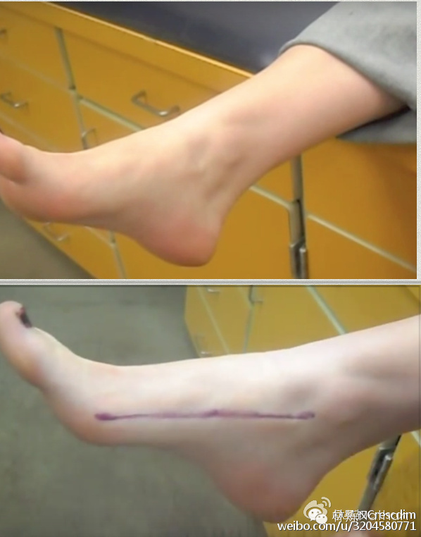 一只脚扁平足怎么矫正,瑜伽扁平足的矫正方法