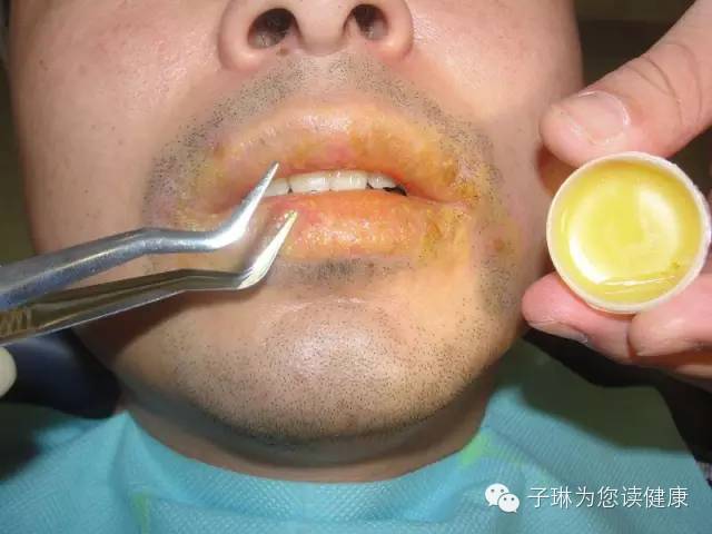 喝酒后嘴唇起皮裂口是怎么回事,嘴唇裂口起皮是什么原因
