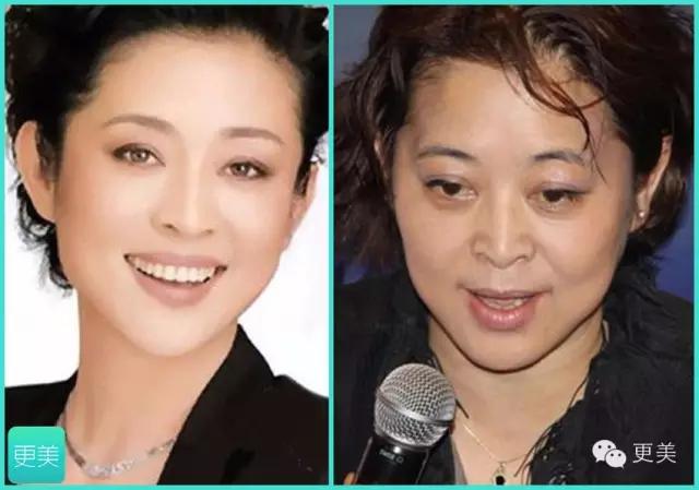 青春定格?4D埋线?音波拉皮?别晕,面部提升就那老三样