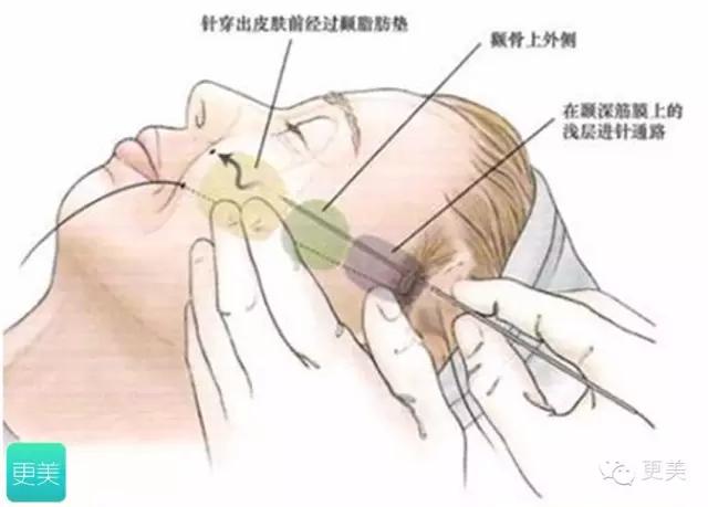 青春定格?4D埋线?音波拉皮?别晕,面部提升就那老三样