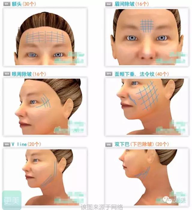 青春定格？4D埋线？音波拉皮？别晕，面部提升就那老三样