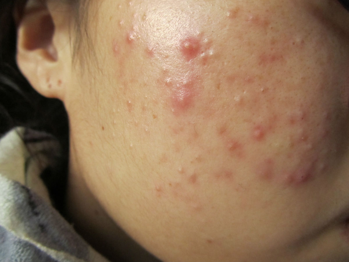 有疮要注意什么,皮肤长疮的最快的治疗方法