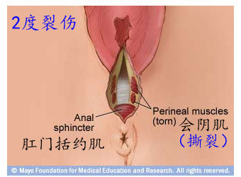 第67课:会阴侧切与撕裂
