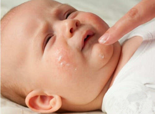 婴儿湿疹皮肤科普讲堂,小婴儿皮肤湿疹怎么办