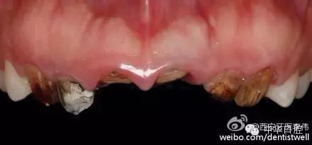 刘涛明星换牙是真是假,刘涛是全种植牙还是换牙