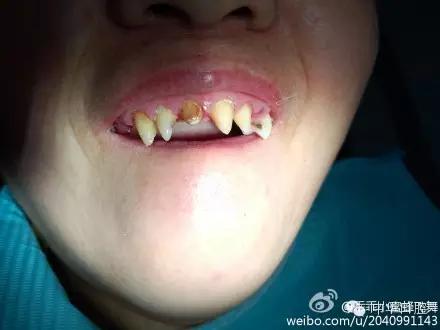 刘涛明星换牙是真是假,刘涛是全种植牙还是换牙