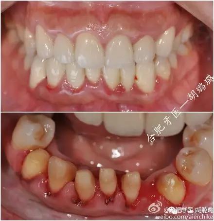 刘涛明星换牙是真是假,刘涛是全种植牙还是换牙