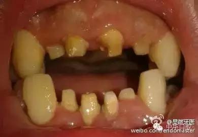 刘涛明星换牙是真是假,刘涛是全种植牙还是换牙