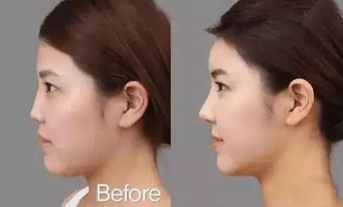 鼻子垫的太往上了,鼻子垫得不高是不是不容易歪