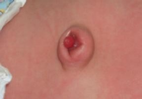 婴儿的脐部是什么东西,新生儿父母注意事项