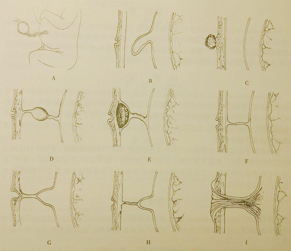 婴儿的脐部是什么东西,新生儿父母注意事项