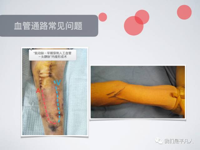 血透净化标准操作规程,血透护理科普怎么完成