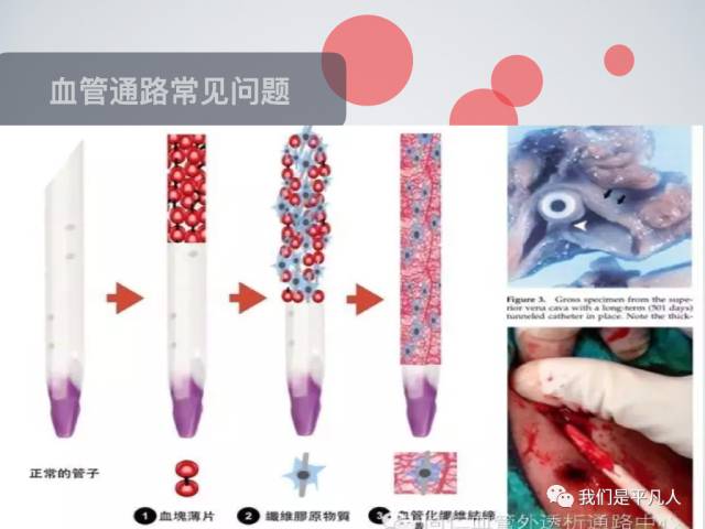 血透净化标准操作规程,血透护理科普怎么完成