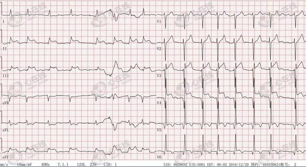 急性心肌梗死心源性休克时的处理,急性心肌梗死心源性休克最常见
