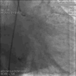 急性心肌梗死心源性休克时的处理,急性心肌梗死心源性休克最常见