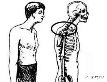 中医含胸驼背体态纠正,日本平背体态矫正