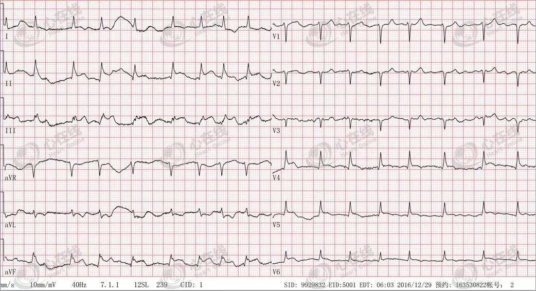 急性心肌梗死心源性休克时的处理,急性心肌梗死心源性休克最常见