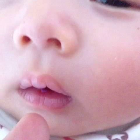 宝宝患上鹅口疮怎么办,宝宝得了鹅口疮的表现是什么