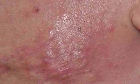 痘痘引起肿胀,痘痘引起的肿块是什么