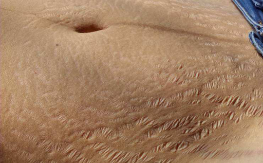 预防妊娠纹的按摩手法,孕期预防妊娠纹的按摩方法