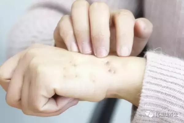 身上的肉瘊对身体有什么影响,身上肉里有疙瘩属于啥病