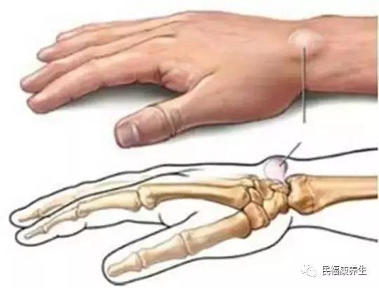 身上的肉瘊对身体有什么影响,身上肉里有疙瘩属于啥病