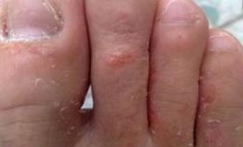 有脚气饮食要注意什么,糜烂型脚气注意事项