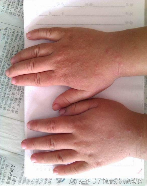 宝宝手上沙土皮炎怎么办,孩子手背沙土皮炎图片