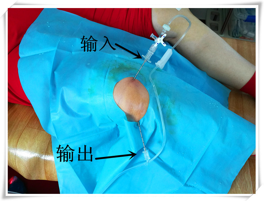 臭氧治疗膝关节炎的效果怎样,膝关节炎臭氧治疗一般可以做几次