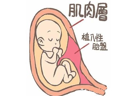 31岁孕妇在医院剖腹产,胎儿34周剖宫产取出可以存活吗