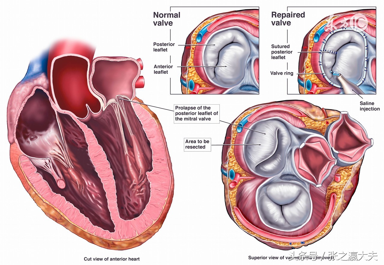 达比加群房颤患者可选用么,房颤消融术后服达比加群多长时间