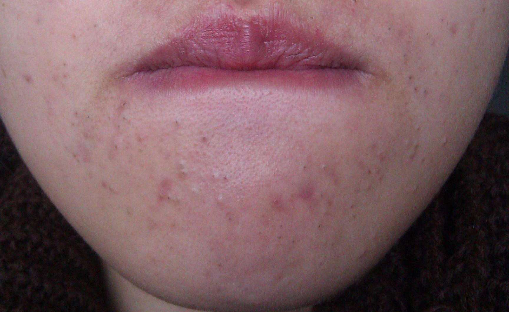 下巴长针眼大小白脓点是怎么回事,下巴有毛毛刺是什么原因