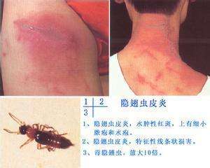 隐翅虫叮咬后皮肤变硬,隐翅虫叮咬后的症状图