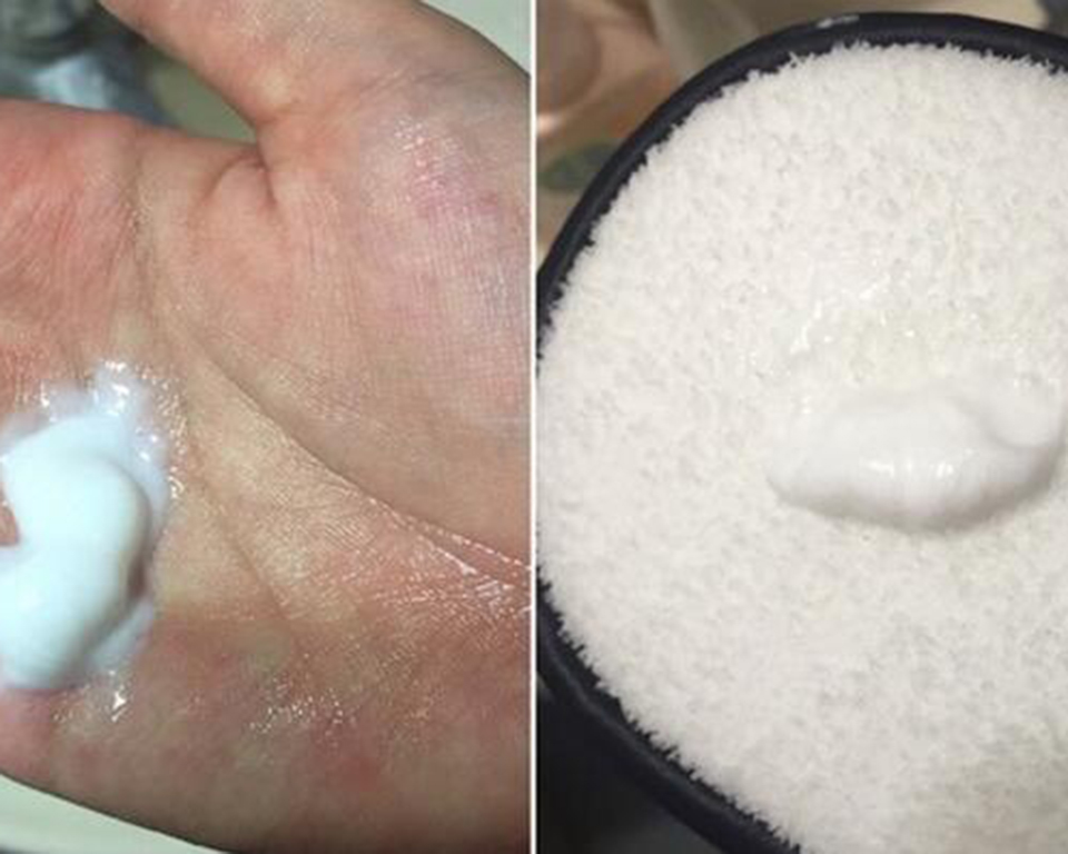 发际线长痘痘是什么原因，如何祛痘