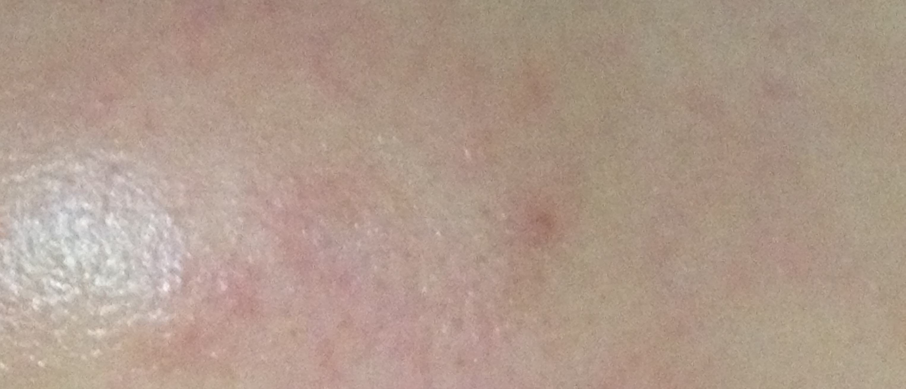 下巴长针眼大小白脓点是怎么回事,下巴有毛毛刺是什么原因