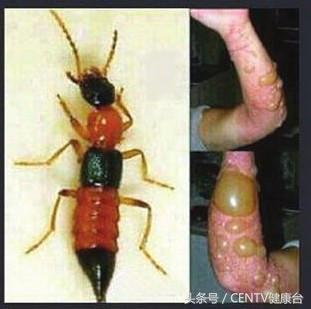 密密麻麻的飞虫怎么治,生活知识隐翅虫有毒切勿直接拍打