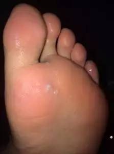 脚板磨出水泡还能继续打球吗,打球磨出水泡怎样处理