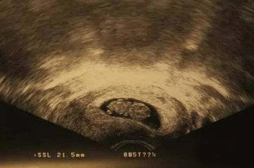 阴超比腹部b超更早看到宫外孕吗,阴超比腹部b超更快看到胎心吗