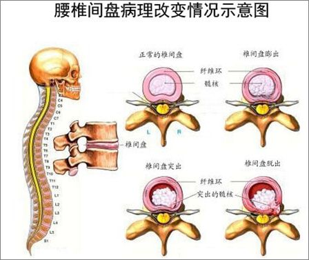 腰椎间盘突出4个等级，你到第几级了？