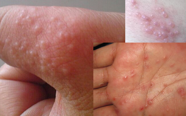 儿童热天手上有水泡是怎么回事,一到热天指尖就起小水泡怎么办