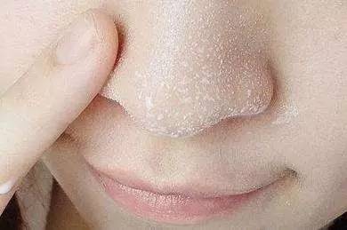 治黑头最有效方法,黑头该怎样解决