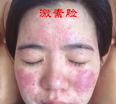 激素脸的症状和激素脸的治疗方法,到底什么是激素脸都有哪些症状
