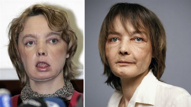 整容换脸最好的方法 (怎么整形才能换脸)